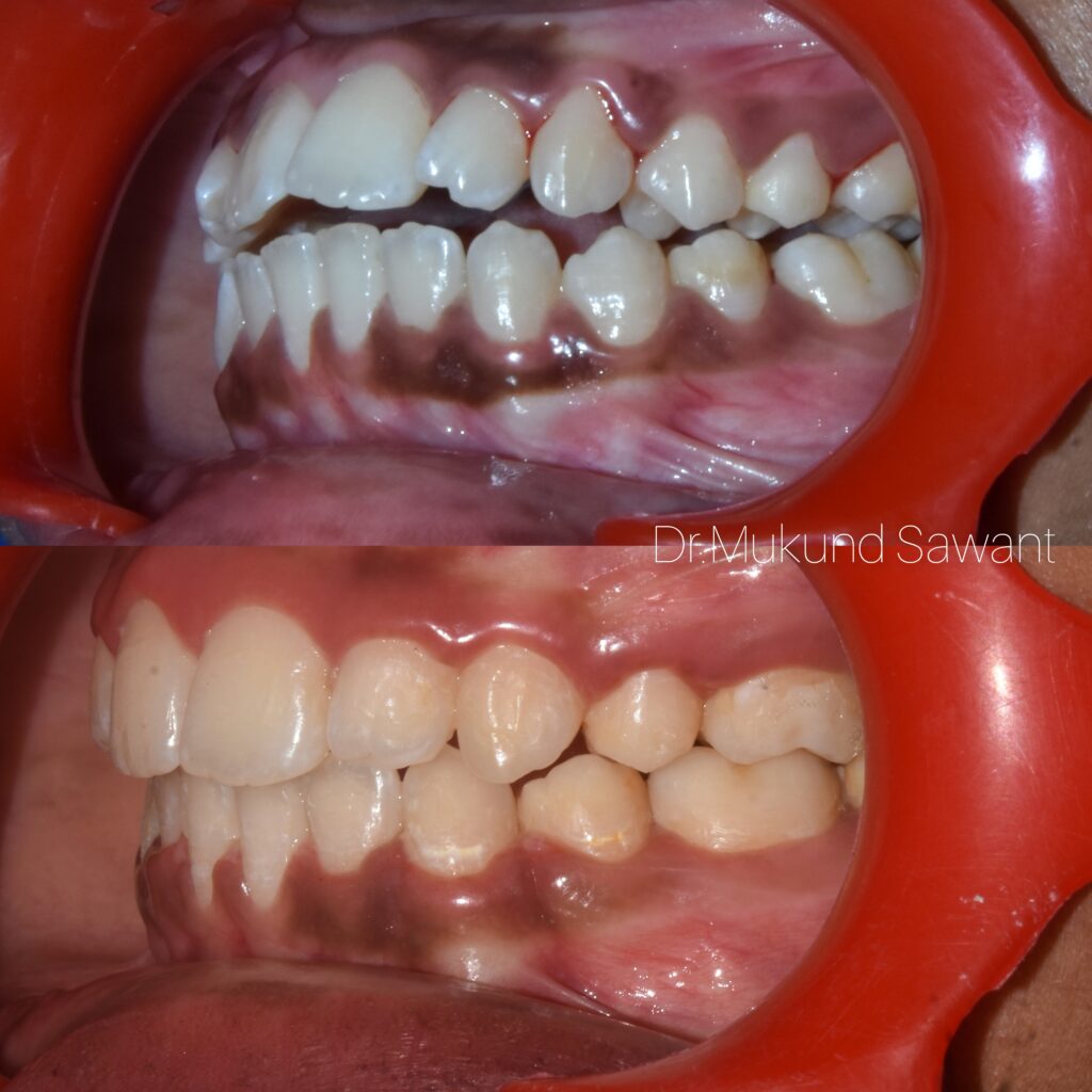 Aligner correction